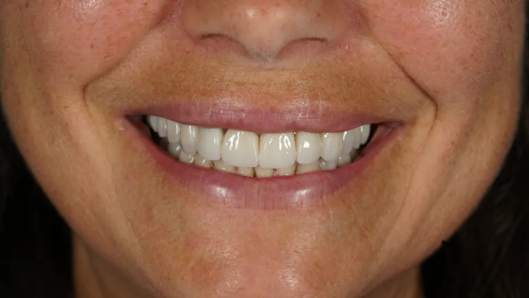 Reabilitare estetică completă ceramică