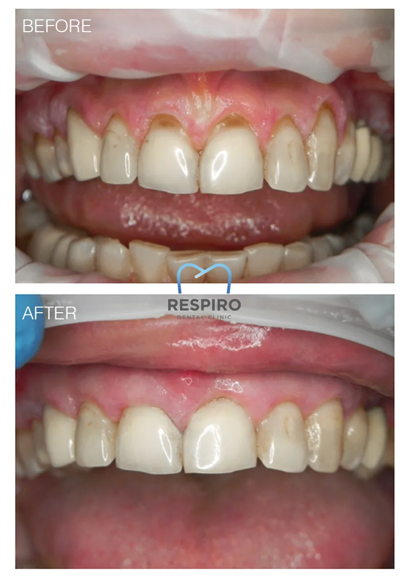 Tehnica Pinhole® — retracție gingivală frontală