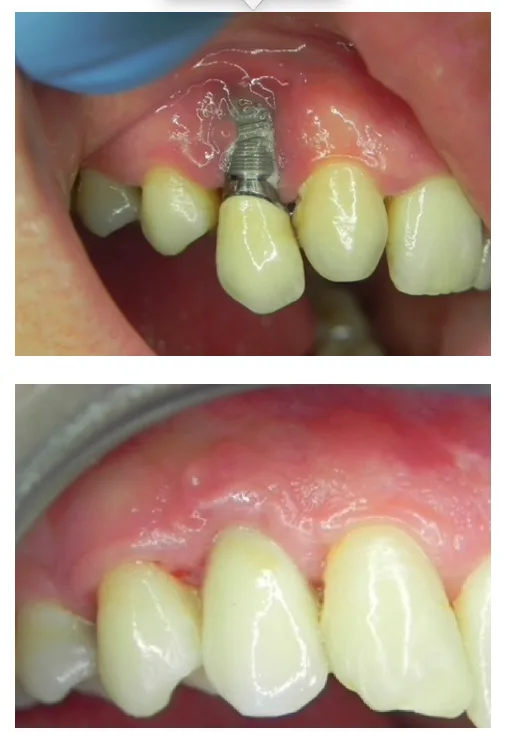 Implant pe os resorbit — MegaGen AnyRidge®