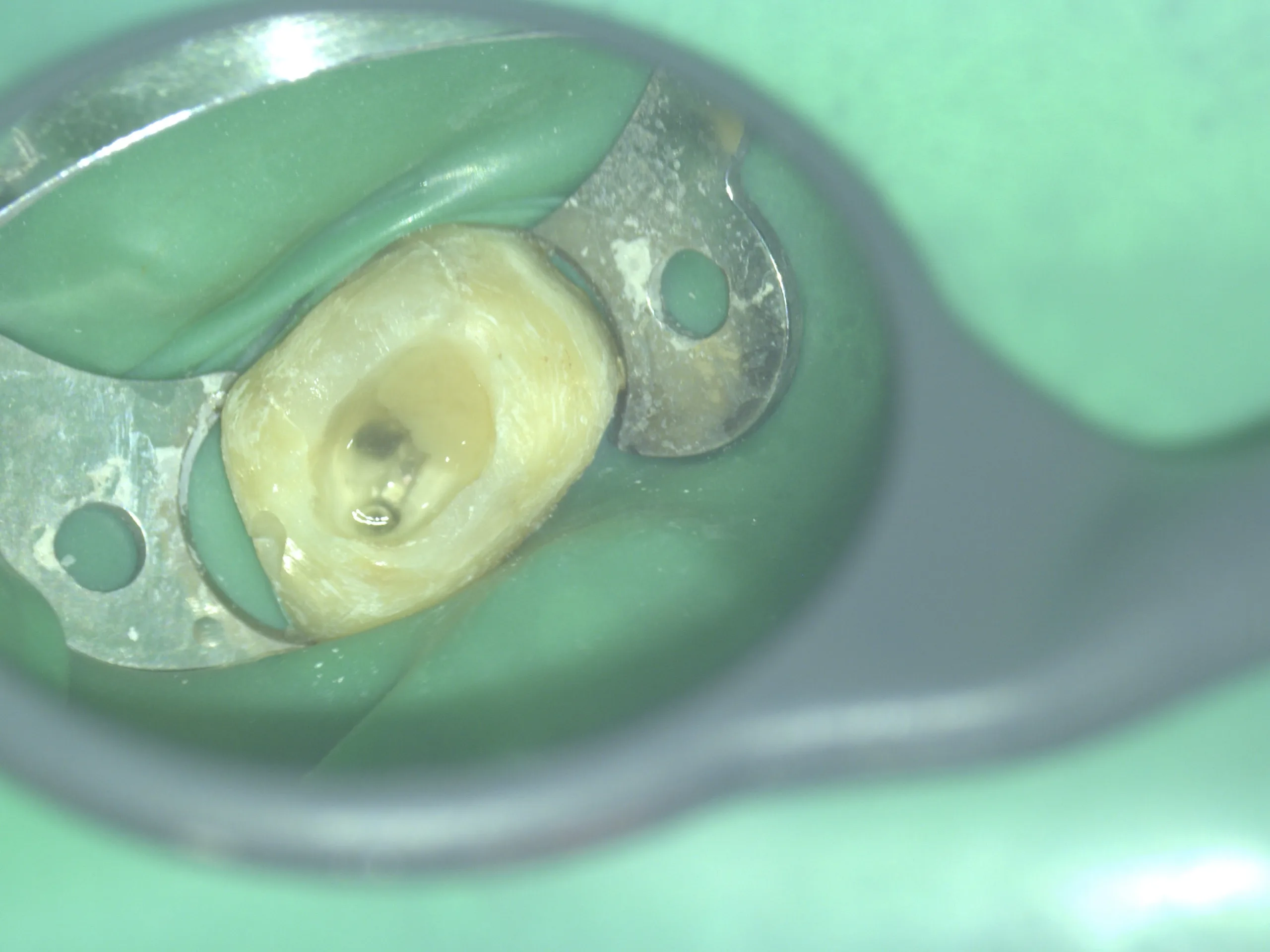Tratament canal molar sub microscop