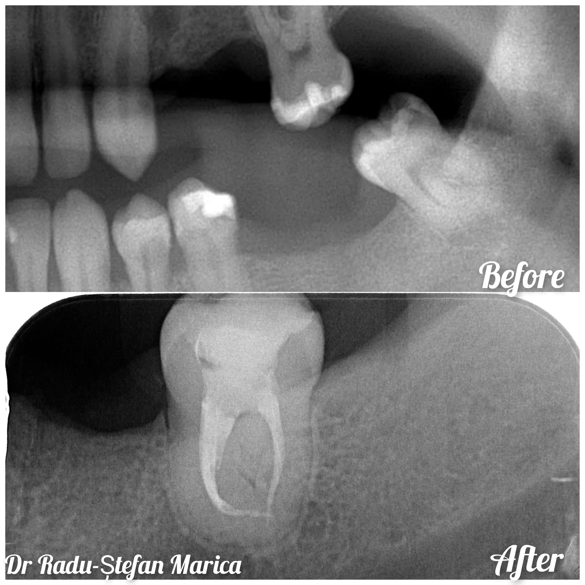 Canal molar de minte — extracție vs. păstrare