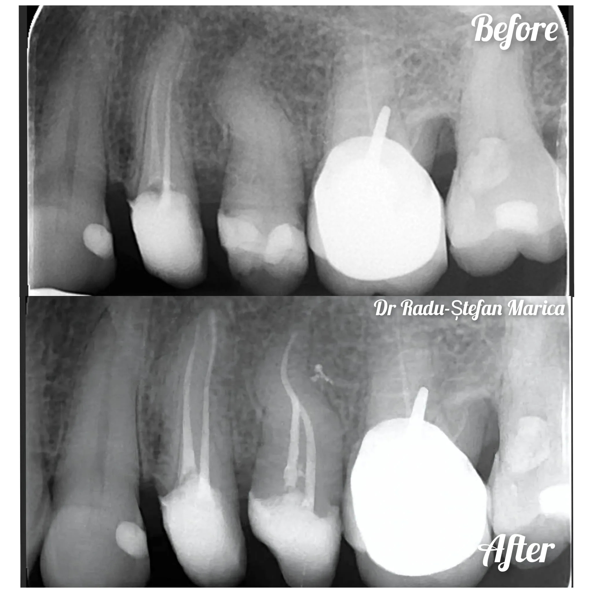 Retratament canal curbat premolar