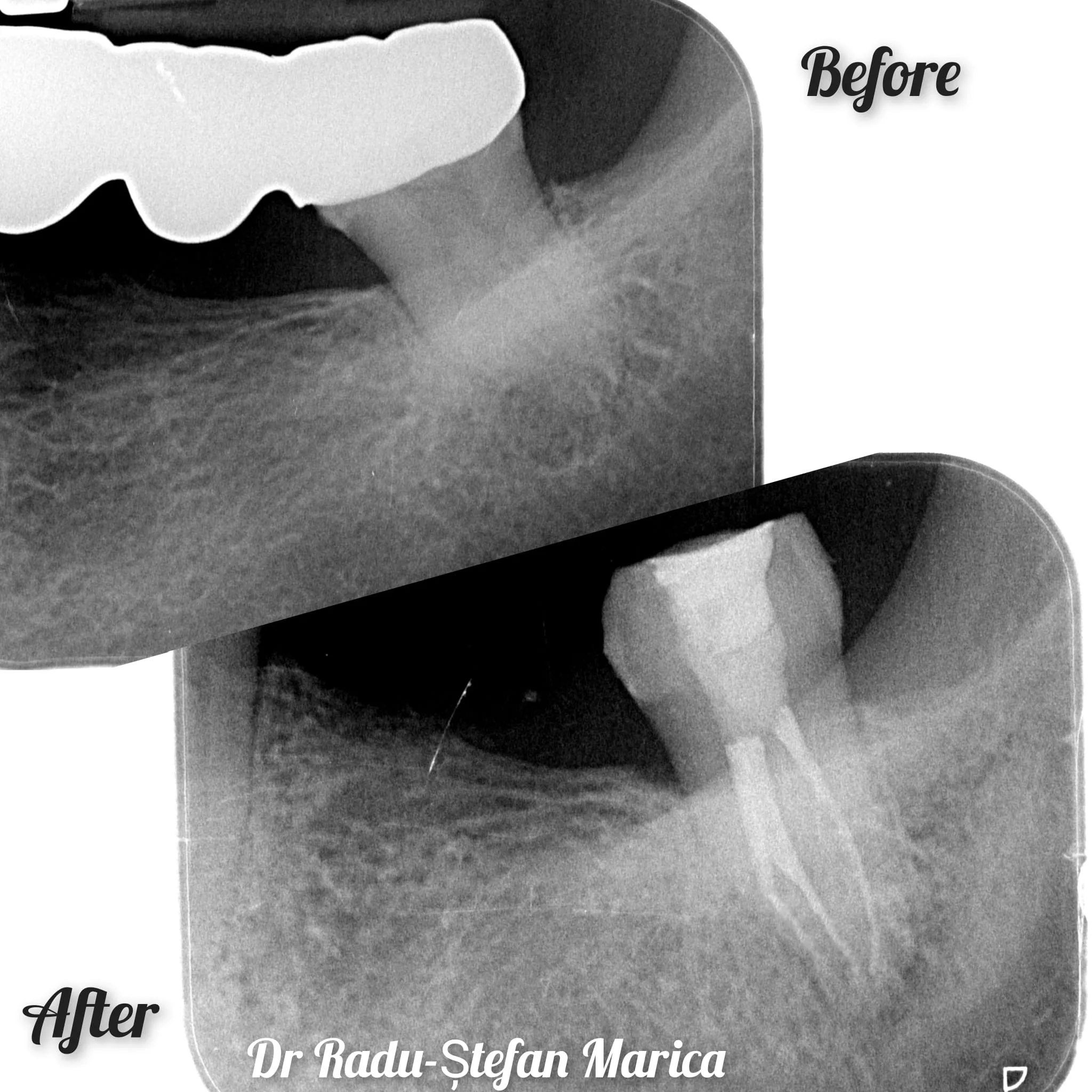 Tratament molar de minte inferior