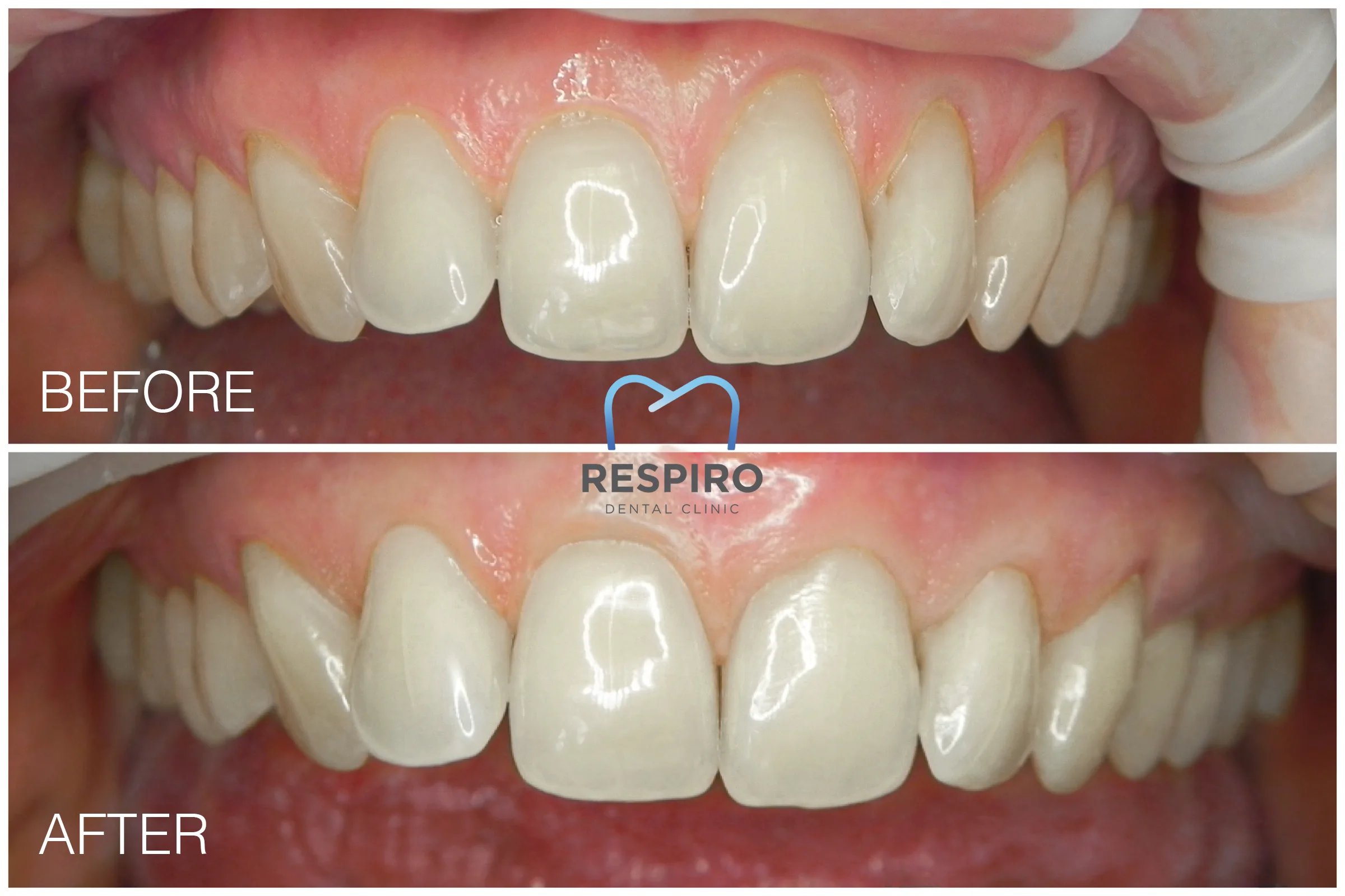 Regenerare cu A-PRF + lambou deplasat