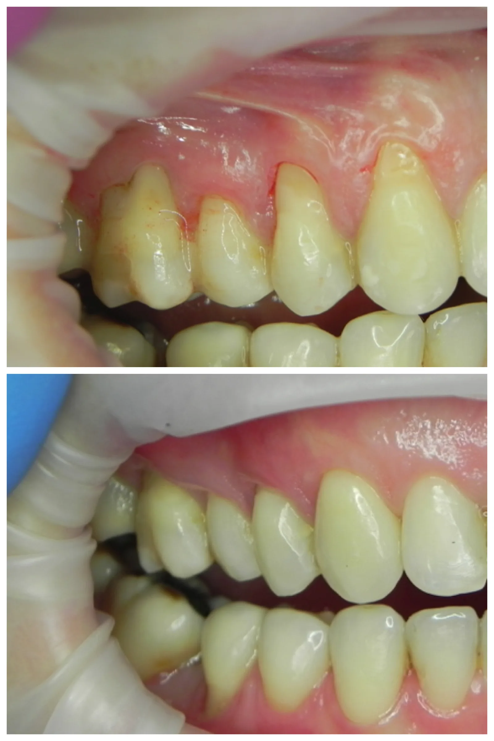Chirurgie mucogingivală — corecție estetică